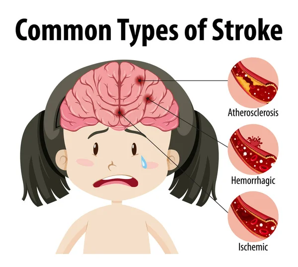 Människa Med Vanliga Typer Stroke Illustration — Stock vektor