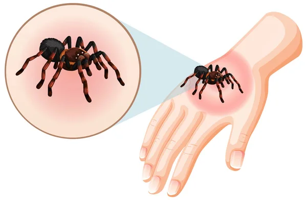 Spider Bites Sting Skin Illustration — Stock Vector