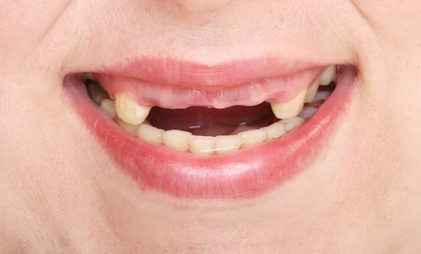 Mun som visar en ruttna tänder. — Stockfoto