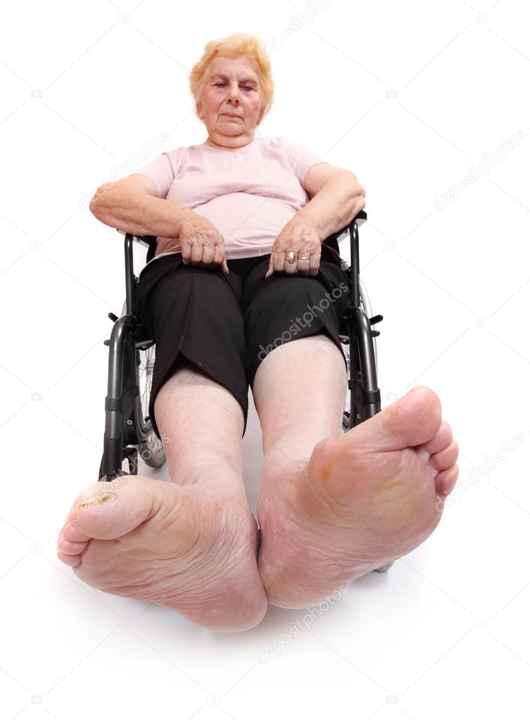 Legs disease of an elderly paraplegic woman sitting in a wheelchair.