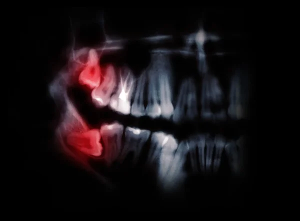 Горизонтальные зубы мудрости, отмеченные красными пятнами — стоковое фото