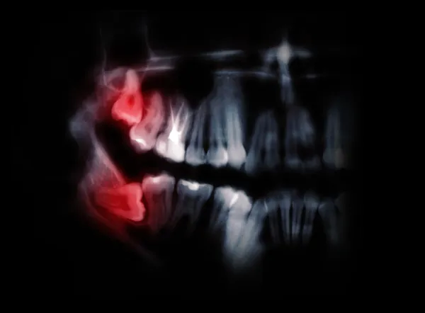 Горизонтальные зубы мудрости, отмеченные красными пятнами Стоковое Изображение