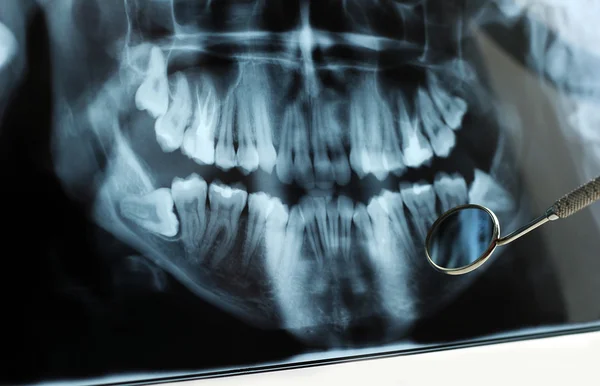 Radiographie dentaire reflétée dans le miroir dentaire — Photo