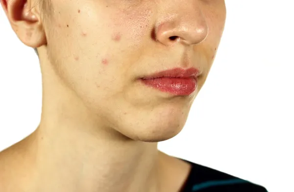 Menina com acne de pele ruim e cabeças pretas — Fotografia de Stock