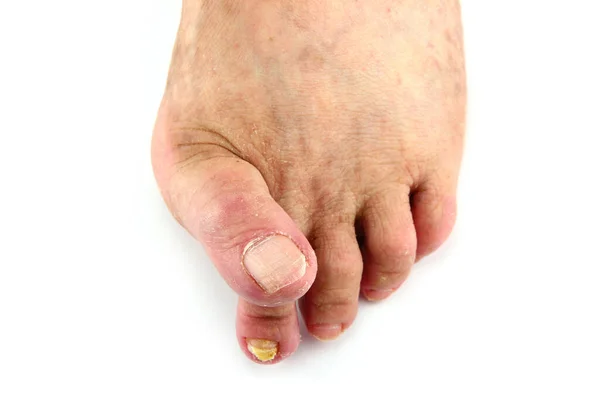 Sick Feet Bunions Blisters Overlapped Toes Vascular Problems Varicose Veins — Stock Photo, Image