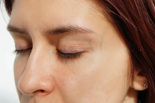 Wanita Sebelum Laser Pengobatan Dengan Pembuluh Laba Laba Dan Kapiler — Stok Foto