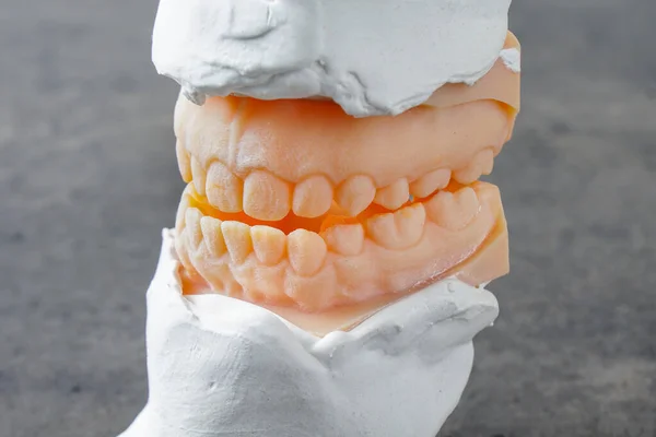 Moule Dents Malocclusion Underbite Utilisé Pour Chirurgie Mâchoire — Photo