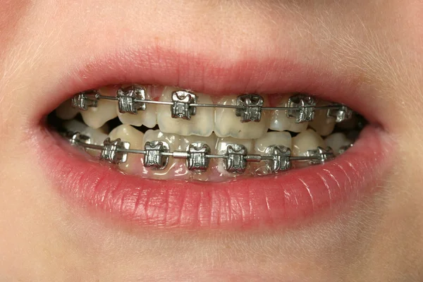 Dental Braces — Stock Photo, Image