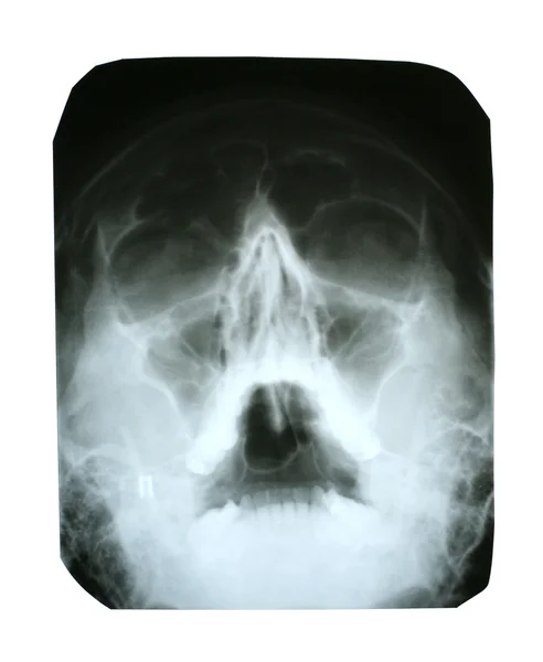 X-ray of Human Head — Stock Photo, Image
