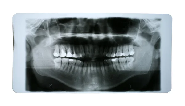 X-ray lidská ústa s náplní — Stock fotografie