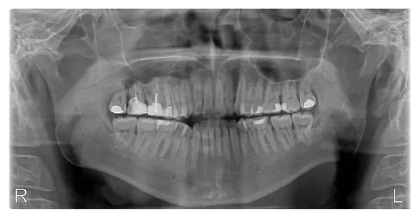 Radiografía de la boca humana con rellenos — Foto de Stock