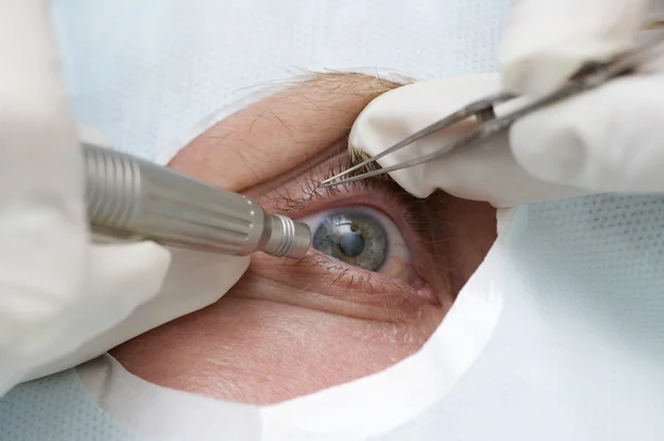 Behandeling van een oog door echografie — Stockfoto