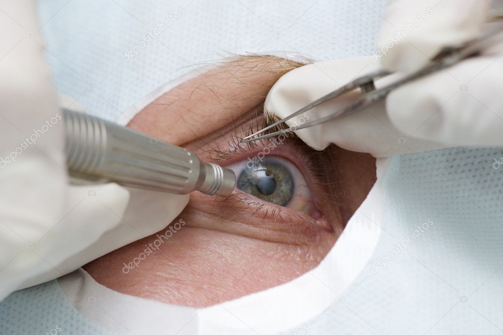 Treatment of an eye by ultrasound
