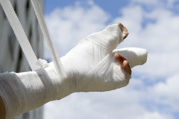 Mano lesionada — Foto de Stock