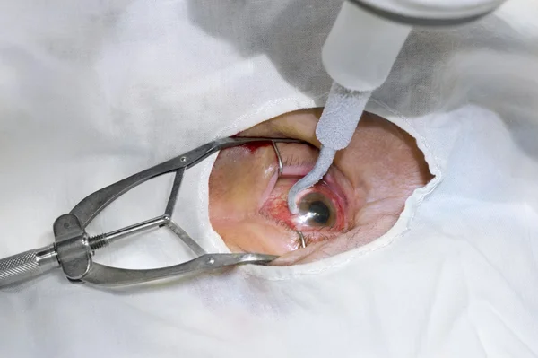 Chirurgie des yeux avec azote liquide — Photo