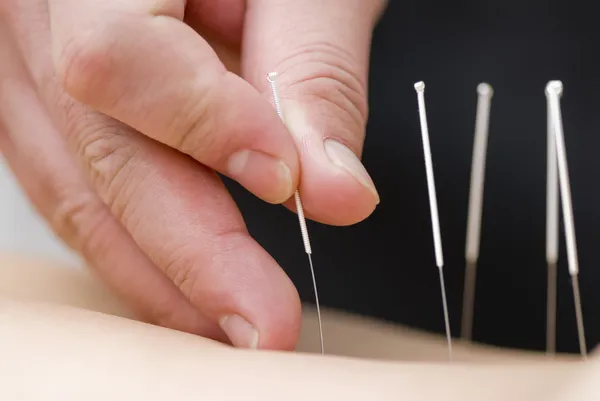 Acupuncture — Stock Photo, Image