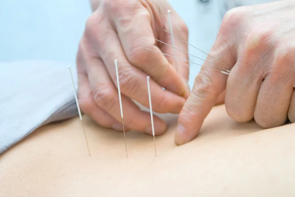 Acupuncture — Stock Photo, Image