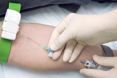intravenöz lazer kan ile