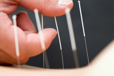 akupunktur