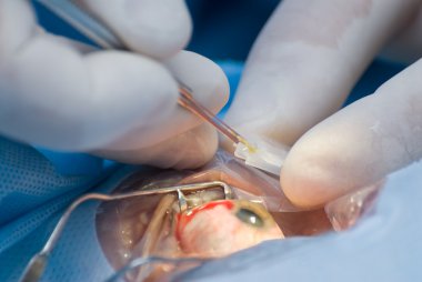 yapay göz içi lens implant