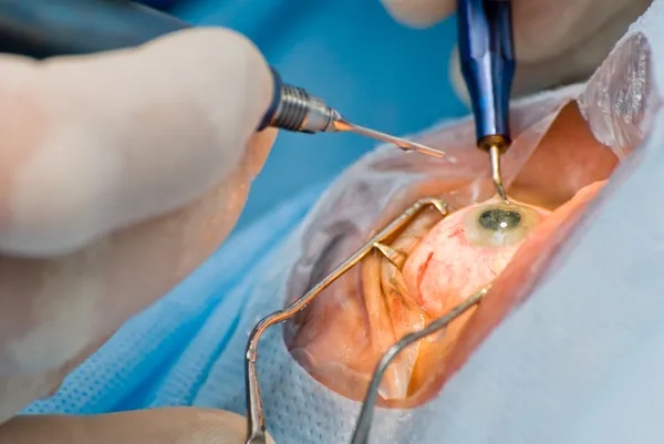 Cataract chirurgie — Stockfoto