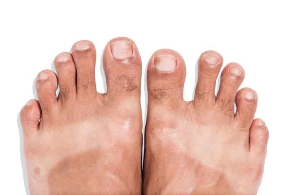 Mark of sunburn on bare foot — Stock Photo, Image