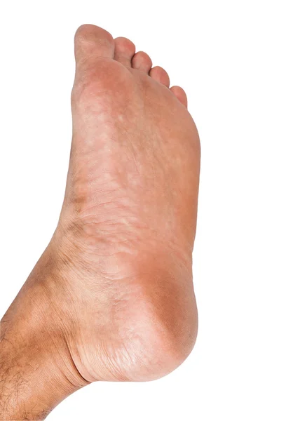 Lap feet or flat foot — Stock Photo, Image