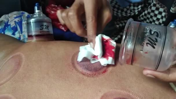 Blora Central Java Indonesia 2021 Cupping Cupping Hijamah Traditional Treatment — Wideo stockowe