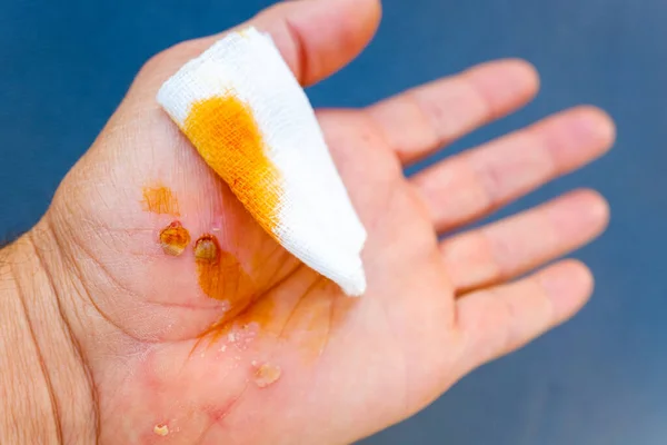 Palma Ferida Com Feridas Arranhões Desinfetada Com Iodo Para Prevenir — Fotografia de Stock