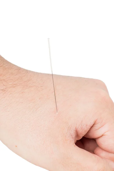 Fechar a agulha de acupuntura — Fotografia de Stock