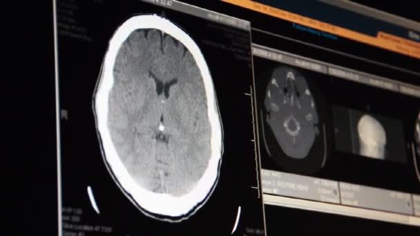 Μια γιατρός εξετάζει σε κεφάλι μαγνητική τομογραφία στην οθόνη του υπολογιστή — Αρχείο Βίντεο