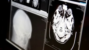 Doktor kafa MRI tarama bilgisayar ekranında ele alıyor..
