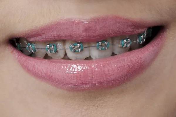 Lábios femininos com aparelho dentário — Fotografia de Stock