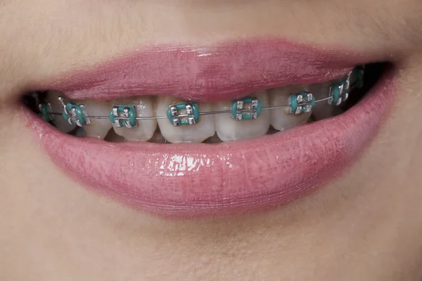 Female lips with teeth braces — Stock Photo, Image