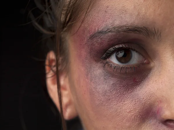 Imagem cortada de um rosto de mulher com hematomas nele — Fotografia de Stock