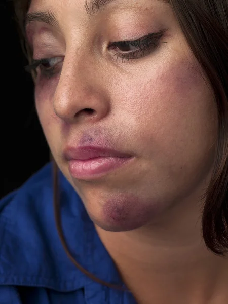 View of a injured woman — Stock Photo, Image