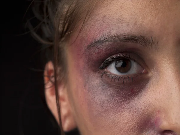 Woman with bruise on her face — Stock Photo, Image