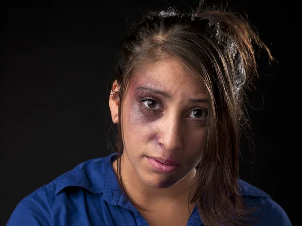 Woman with bruise on her face — Stock Photo, Image