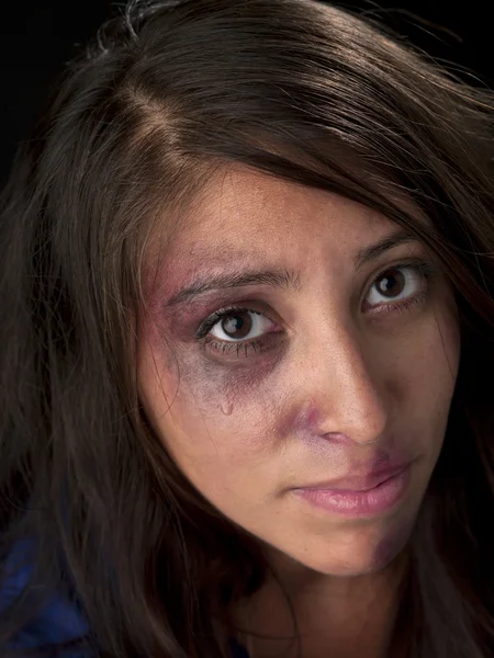 Young woman with bruise on her face — Stock Photo, Image
