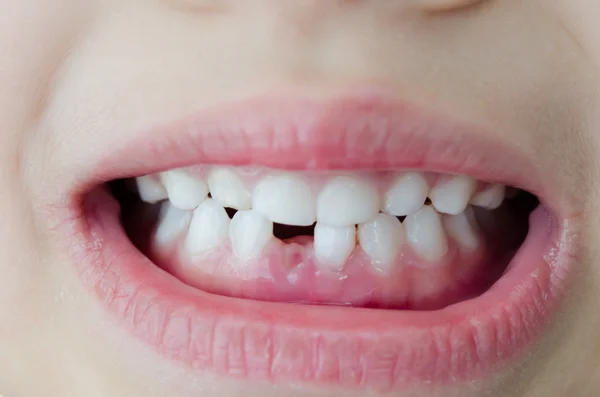 Child broken tooth — Stock Photo, Image