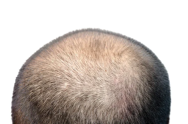 Bald head — Stock Photo, Image