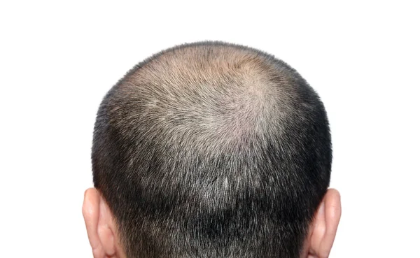 Bald head — Stock Photo, Image