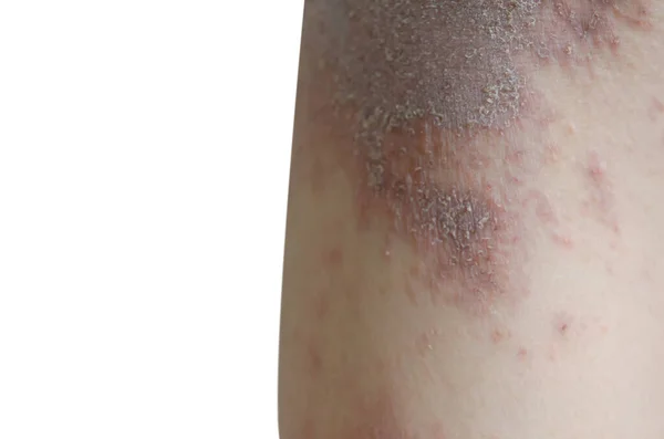 Hautausschlag Und Haut Bein Isoliert Auf Weißem Hintergrund — Stockfoto