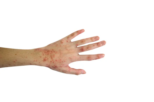 Εξάνθημα Και Δέρμα Στο Χέρι Απομονώνονται Λευκό Φόντο — Φωτογραφία Αρχείου