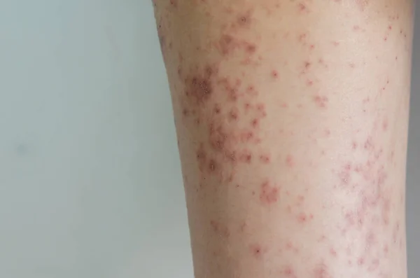 Rash Girl Rosso Malattia Della Pelle Causata Allergie Farmaci Cibo — Foto Stock