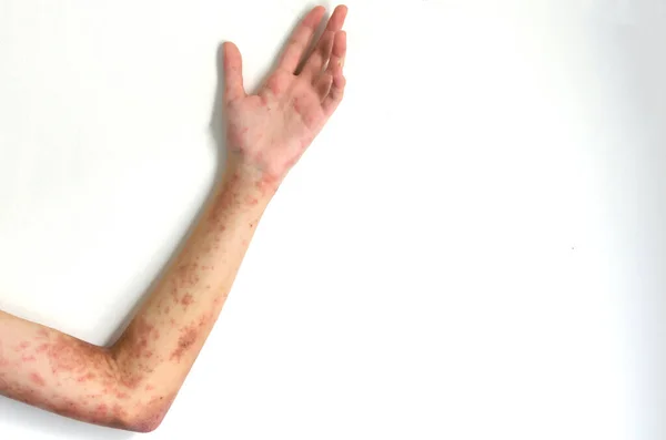 Léčba Atopické Dermatitidy Infekce Svědění Dívčí Paži Zahrnuje Podávání Léků — Stock fotografie