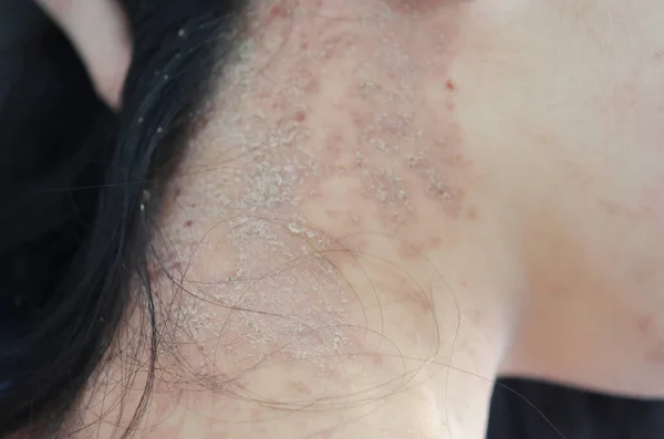 Кожные Сыпи Шее Женщин Вызванные Аллергией Химикаты Продукты Питания Химикаты — стоковое фото