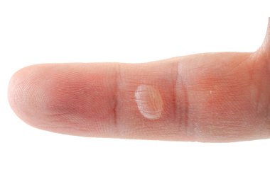 Kurumuş derisi ve lekesi olan bir tamircinin elinin serçe parmağı, tesisatçının vücudunun yüzsüz, beyaz bir arka planda izole edilmiş,.