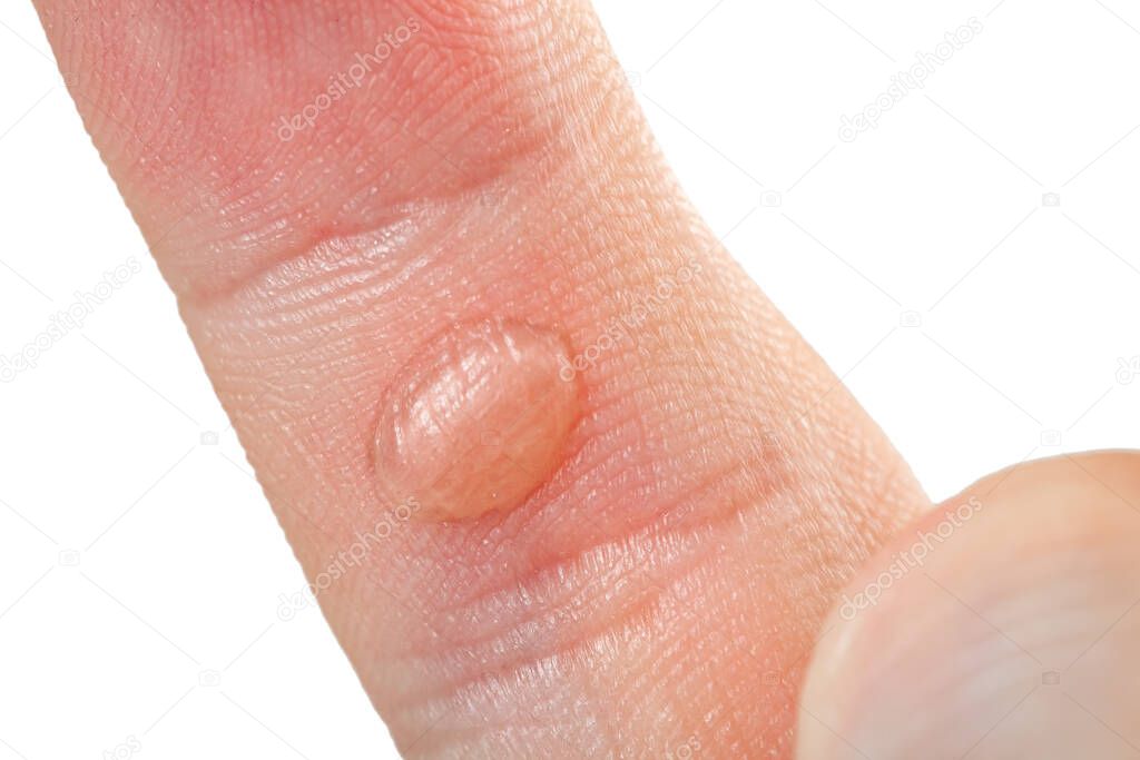 On hand finger there is blister callus with dry skin and trauma on hand of worker, close-up injured body with damage human skin isolated on white.