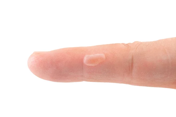 Blister Finger Skin Human Body Damage Callus Health Care Theme — Stock Photo, Image